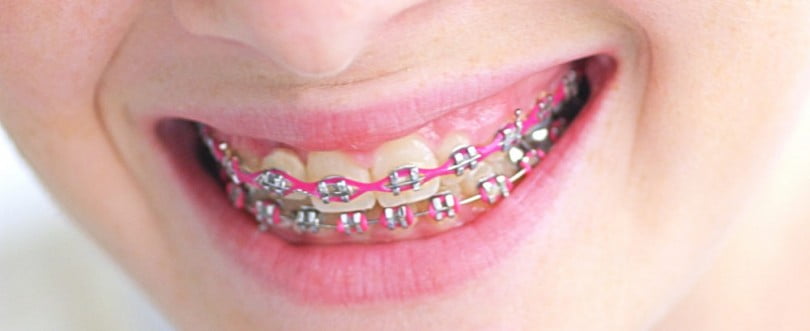 Estudo alerta para micróbios nos aparelhos dentários