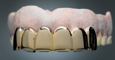 Utilização de ouro em aplicações dentárias em declínio