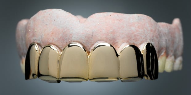 Utilização de ouro em aplicações dentárias em declínio