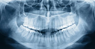 Investigadores descobrem como funciona estrutura interna da dentina