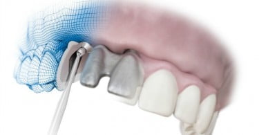 Dentsply Implants apresenta nova função para parafuso angulado de Atlantis Isus