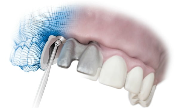 Dentsply Implants apresenta nova função para parafuso angulado de Atlantis Isus