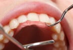 Estudo cria nova forma de classificar severidade de cancro oral