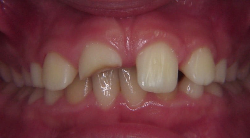 Laser no tratamento de dentes frontais traumaticamente fraturados