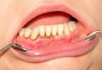 Tratar doenças periodontais em doentes renais pode reduzir risco de doenças cardíacas