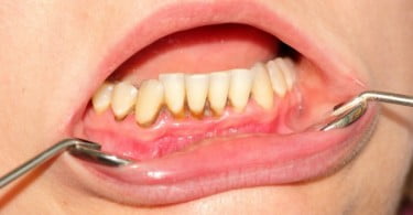 Tratar doenças periodontais em doentes renais pode reduzir risco de doenças cardíacas