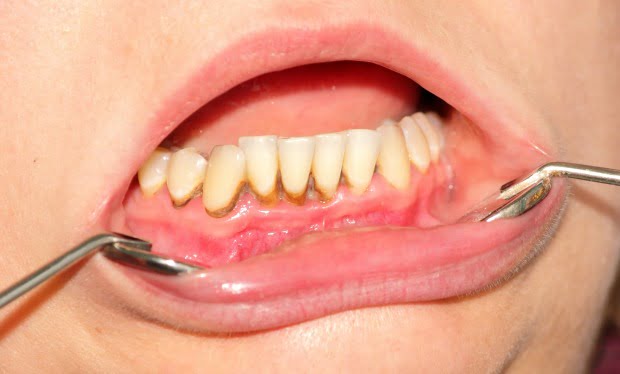 Tratar doenças periodontais em doentes renais pode reduzir risco de doenças cardíacas