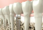 Novo gel promove crescimento ósseo em implantes