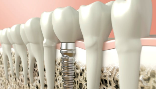 Novo gel promove crescimento ósseo em implantes