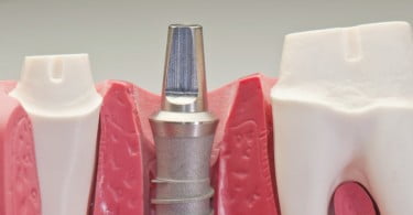 BTI realiza Jornadas de Implantologia