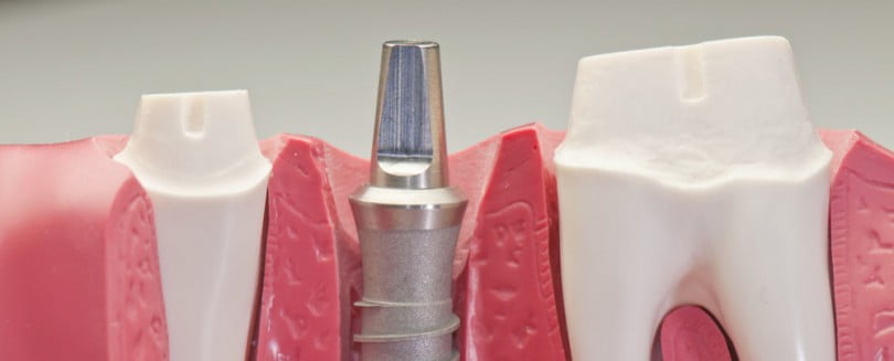 BTI realiza Jornadas de Implantologia