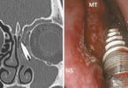 Médicos descobrem implante dentário em cavidade nasal