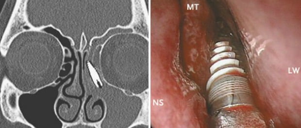 Médicos descobrem implante dentário em cavidade nasal