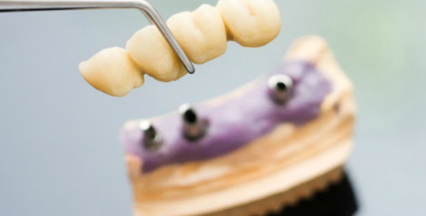 Straumann apresenta novo implante de 4mm Roxolid