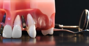 Implantes dentários com crescimento em mercados emergentes