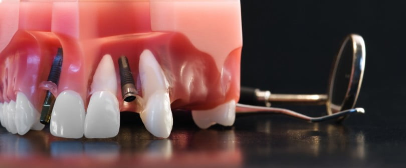 Implantes dentários com crescimento em mercados emergentes