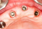 Técnica inovadora em implantes dentários tem assinatura portuguesa