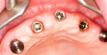 Técnica inovadora em implantes dentários tem assinatura portuguesa