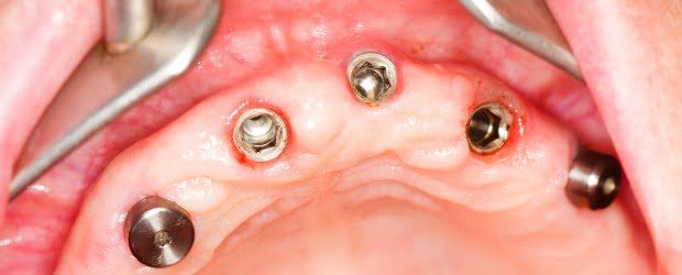 Técnica inovadora em implantes dentários tem assinatura portuguesa