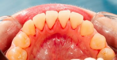 Portugueses criam pastilha contra inflamações da boca