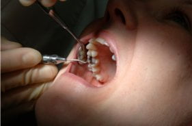 Dentistas e organizações juntos na luta contra a cárie