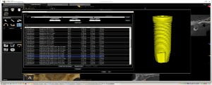 Carestream Dental atualiza livraria de implantes
