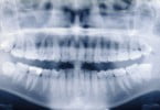 Australianos implantam prótese temporomandibular impressa em 3D