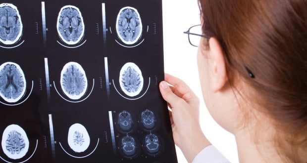 Tumor raro faz crescer dentes no cérebro de criança