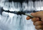 Cientistas criam nova geração de implantes dentários