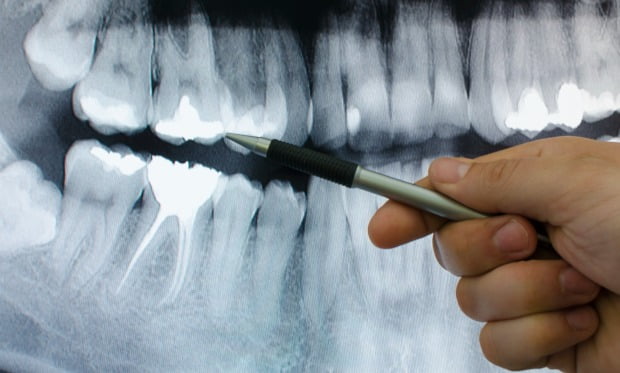 Cientistas criam nova geração de implantes dentários
