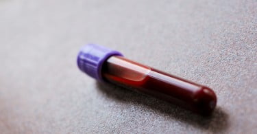 Amostra de sangue pode substituir biópsia