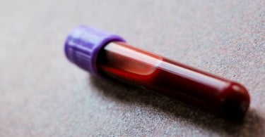 Estudo analisa riscos da cirurgia dentária em pacientes medicados com anticoagulantes