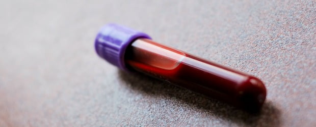 Estudo analisa riscos da cirurgia dentária em pacientes medicados com anticoagulantes