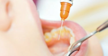Estudo constata que a vacina de ADN inibe a formação de cáries