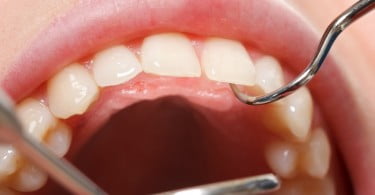 Já existe um material capaz de regenerar o esmalte dentário