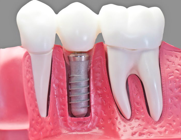 implantes dentários