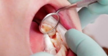 obturações dentárias outubro