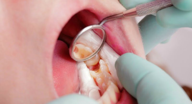 obturações dentárias outubro