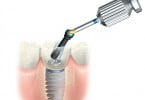 Posterior Solution Nobel Biocare
