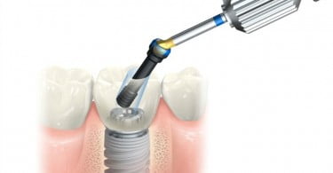 Posterior Solution Nobel Biocare