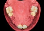 ceramic teeth D