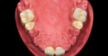 ceramic teeth D