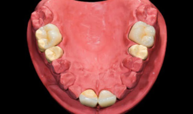 ceramic teeth D
