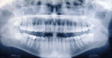 radiografia dentes