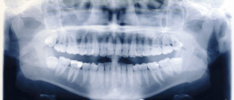 radiografia dentes