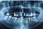 raio de dentes com implantes