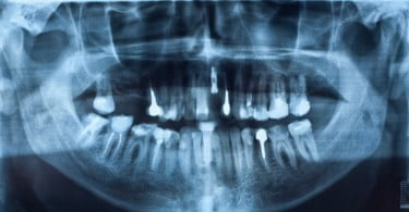 raio de dentes com implantes