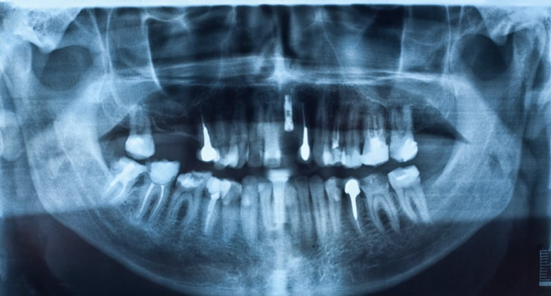 raio de dentes com implantes