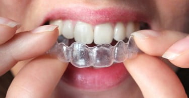 Alineadent dentes