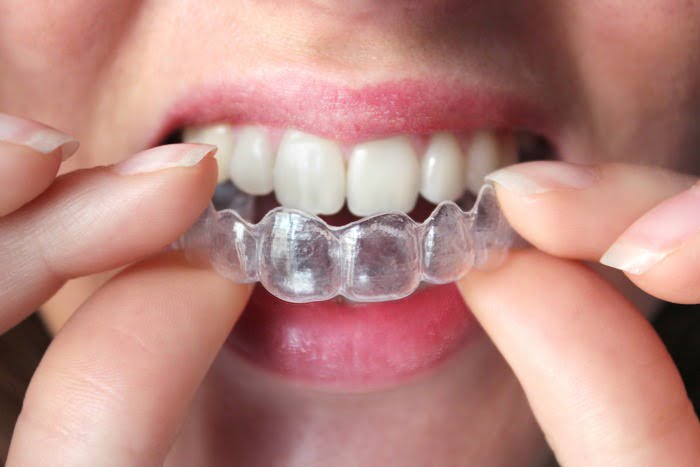 Alineadent dentes